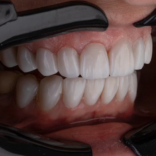 Teeth Whitening Strips